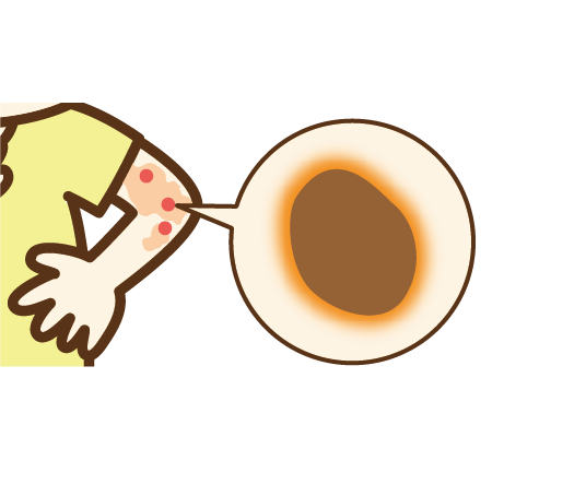 痂皮（かひ）